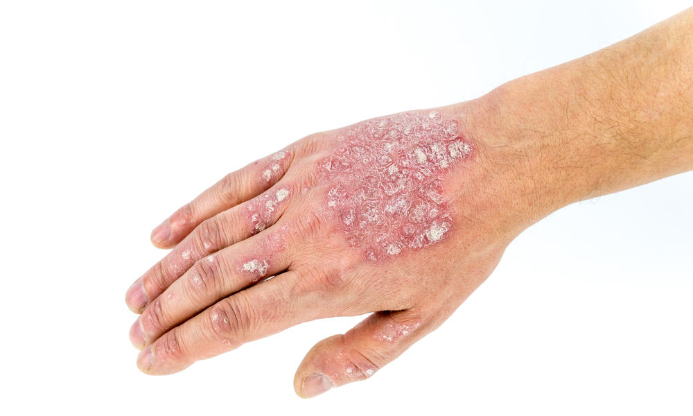 10 Best Weed Strains For Psoriasis