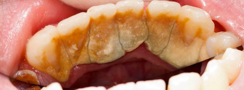 Long Term Cannabis Use Linked To Gum Disease: Could Make Your Teeth Fall Out
