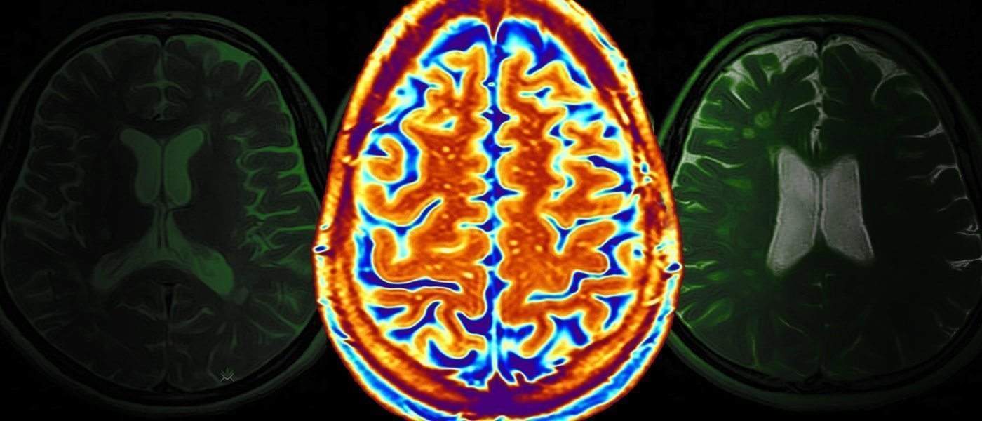 Research Shows Marijuana Can Reduce Side Effects of Multiple Sclerosis
