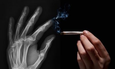 How Cannabis Can Help Heal Broken Bones